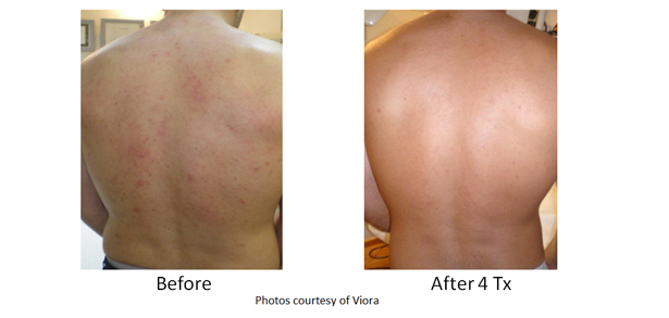 Acne - Before & After