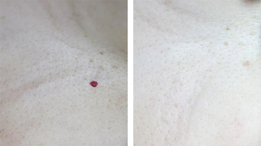 Hemangioma Before and After