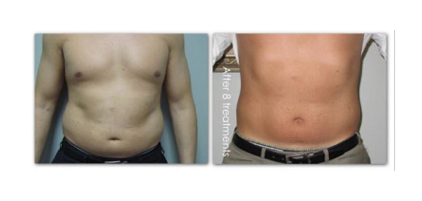 Laser Lipo - Before & After