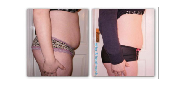 Laser Lipo - Before & After
