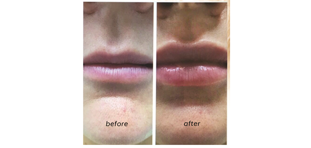 Lip Plump Before and After