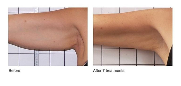 ReFit Body Tightening - Before and After