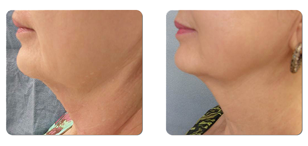 Chin Before and After