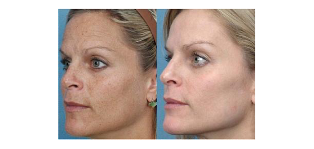 Skin Rejuvenation - Before and After