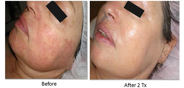 Skin Rejuvenation - Before and After