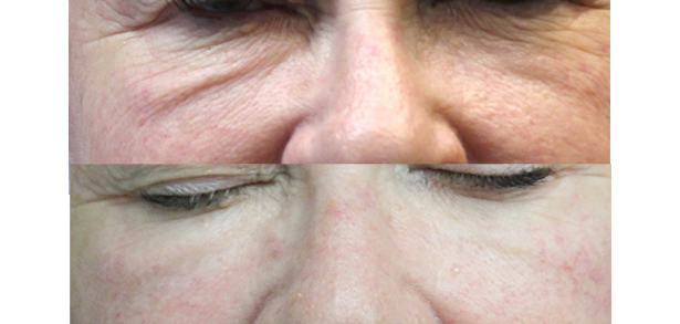 Skin Rejuvenation (Eyes) Before and After
